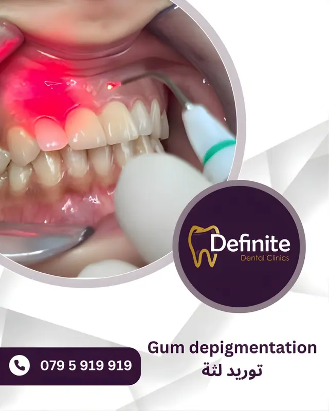 Gum Depigmentation