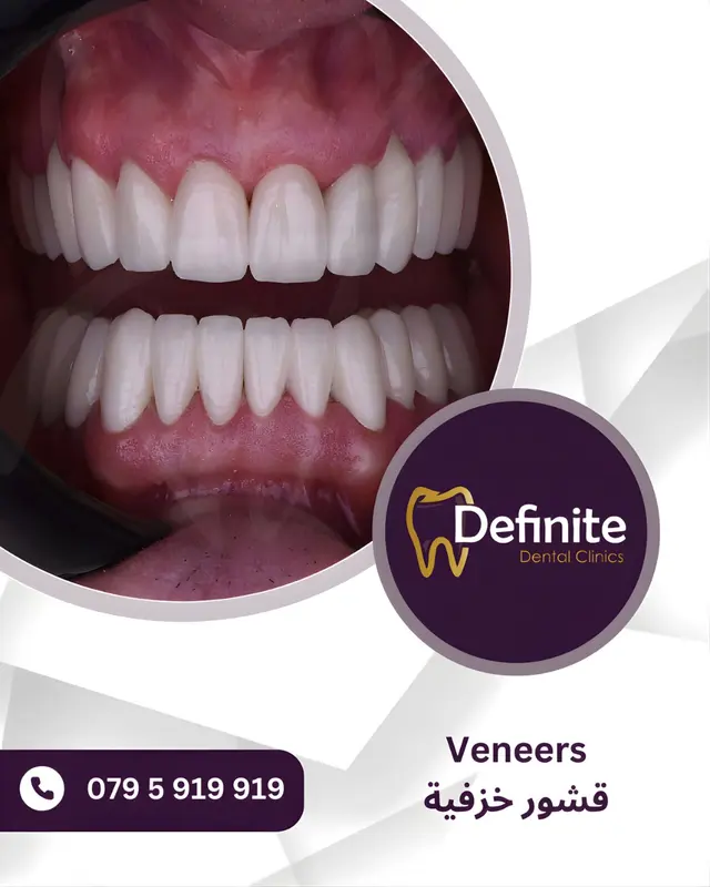 Veneers
